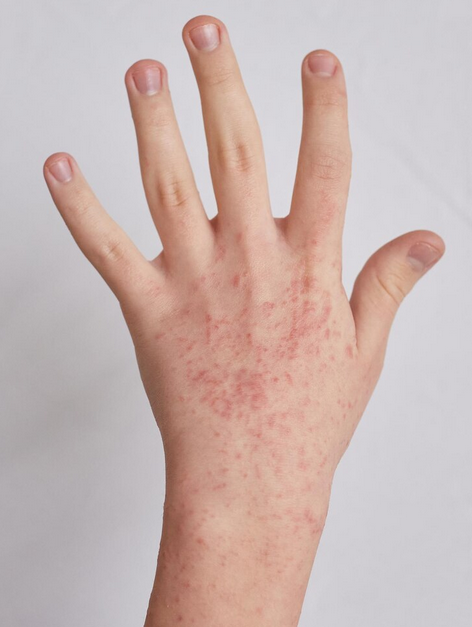 ما هي الأكزيما؟